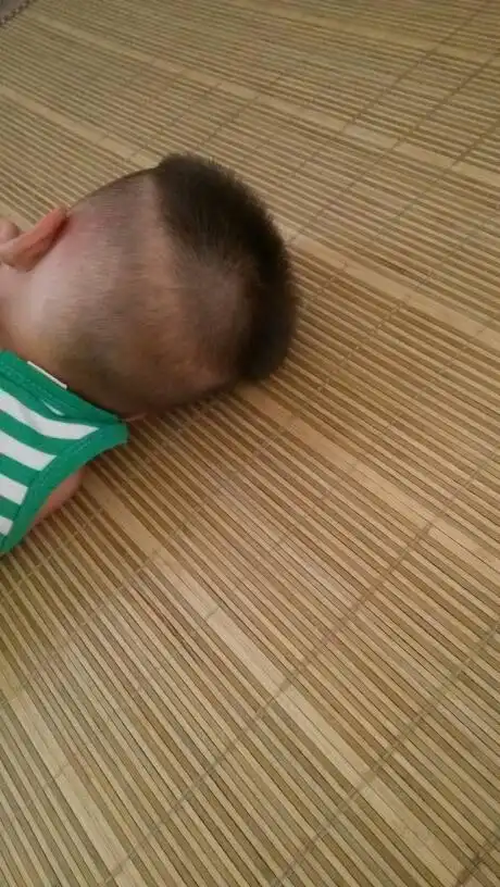 1岁多宝宝头上出现一圈白色的是什么情况,哪位能解决一下?