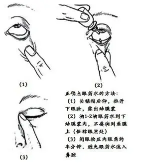 3,一般眼药水点1滴就够了,如果滴到眼外,可以补一滴,因为结膜囊其实很