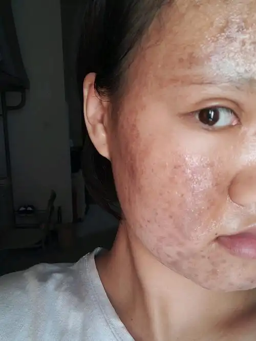 刷酸第一天 大面积深色结痂