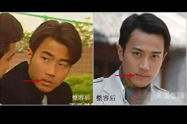 整容部位三:鼻子 网友贴图称刘恺威整容前鼻子比较塌,而鼻头和鼻翼倒