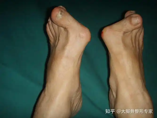 那些不做手术的拇外翻,会发展到怎么样 - 知乎