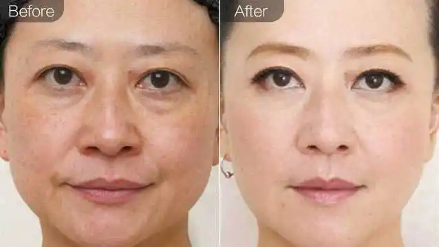 去眼袋手术恢复期多久,去眼袋手术要多久恢复正常~咋肿肿的