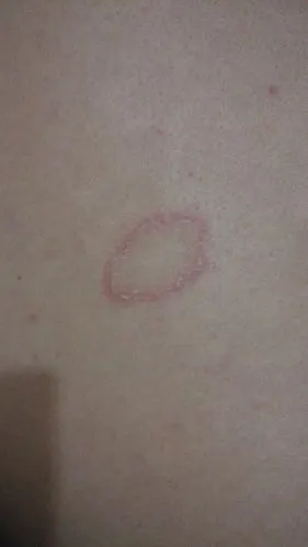 一起发帖说有的说是皮癣,有的说是皮炎.