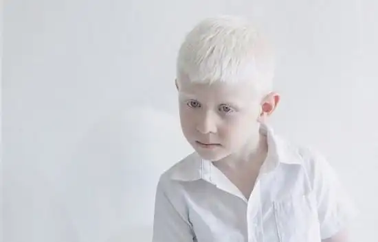 俄摄影师拍摄白化病人,遗落在凡尘的白色天使!