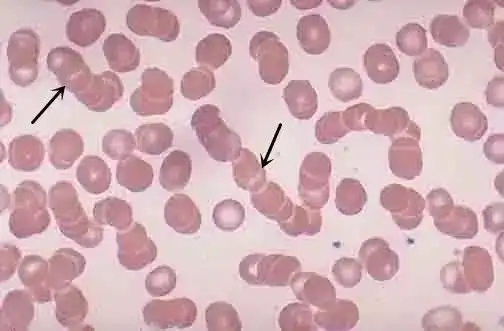 锯齿形红细胞锯齿形红细胞,细胞突起较棘形细胞短,但分布均匀,长短较