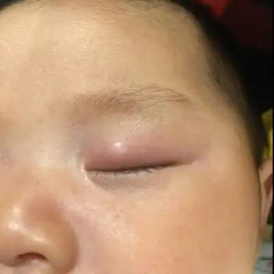 宝宝眼皮上有个疙瘩请问有知道怎么回事的吗?