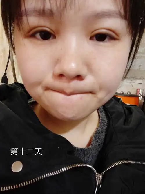 埋线双眼皮感觉失败