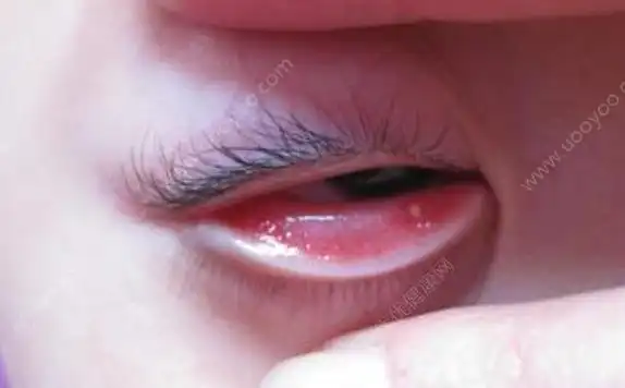 上眼皮里面长了个疙瘩 上眼皮里长了个小白点[多图] - 大众健康网