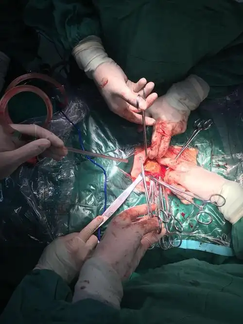 临泉县中医院泌尿外科成功完成一例特大膀胱结石手术