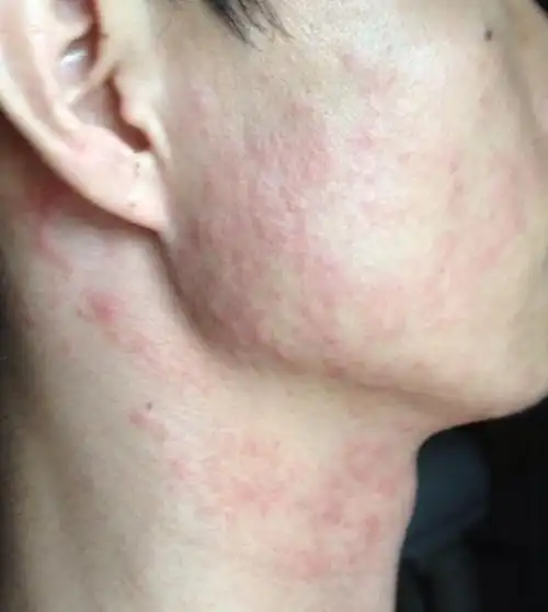 全面了解神经性皮炎摆脱皮肤瘙痒不是梦