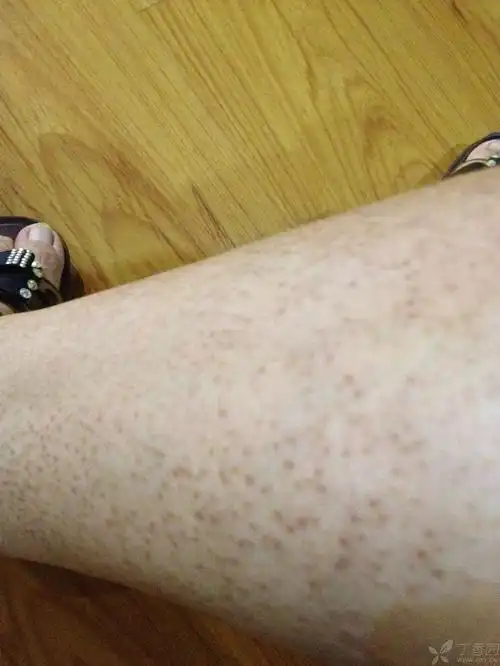 双下肢斑点 - 皮肤性病 -丁香园论坛