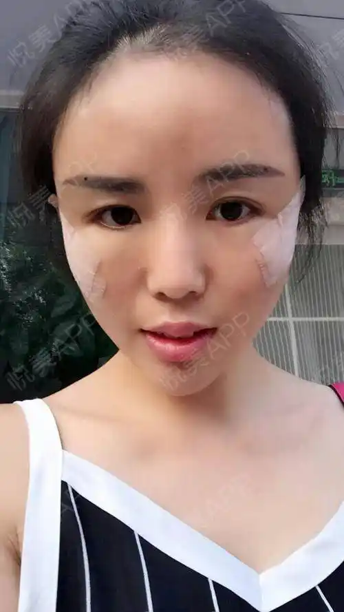 自体脂肪面部填充术后4天_自体脂肪丰下巴术后4天_面部填充术后4天_垫