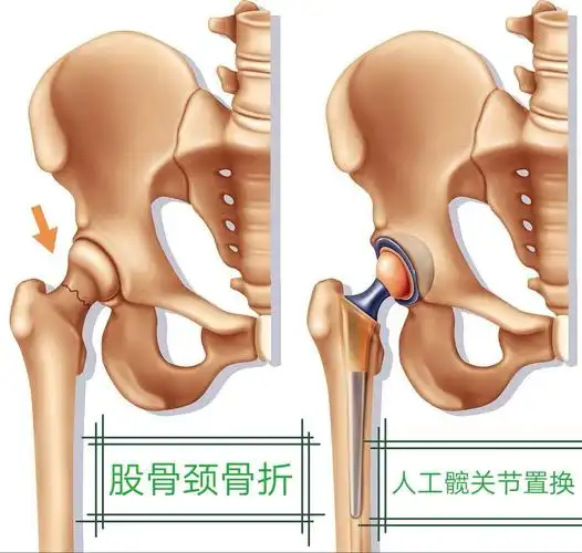 康复训练——髋关节置换