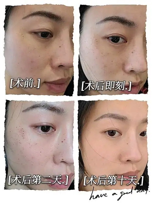 项目:光子嫩肤术后第十天术后十天了,我这个痂皮掉得_圈子-新氧美容