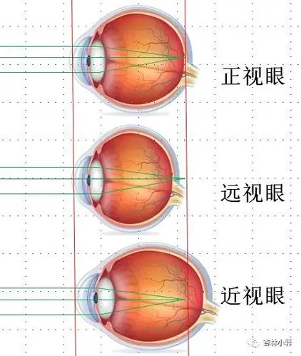 3,近视眼:是眼轴前后变长了.外界物成像体通过眼的屈光系统落在了