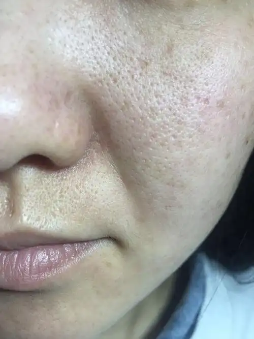 1月5日,毛孔非常粗大,可怕