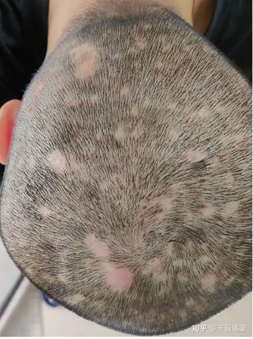 首先@写轮眼提到毛囊炎有三种一种是真菌引起的真菌感染毛囊炎这就是