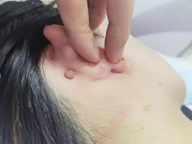 37岁王女士患表皮样囊肿激光治疗后病情好转