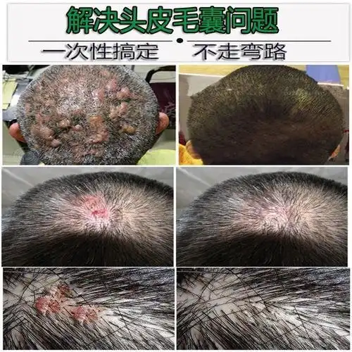 毛囊炎薬膏止痒膏头部背部脓包痤l疮湿珍痘痘疙瘩治头皮毛囊炎皮肤