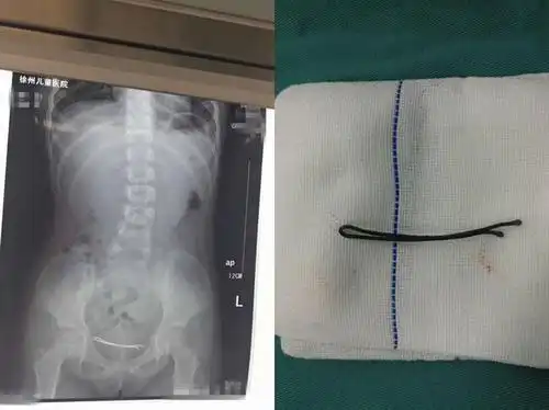 痛!徐州11岁男童尿血尿痛,医生手术取出异物惊呆家属.