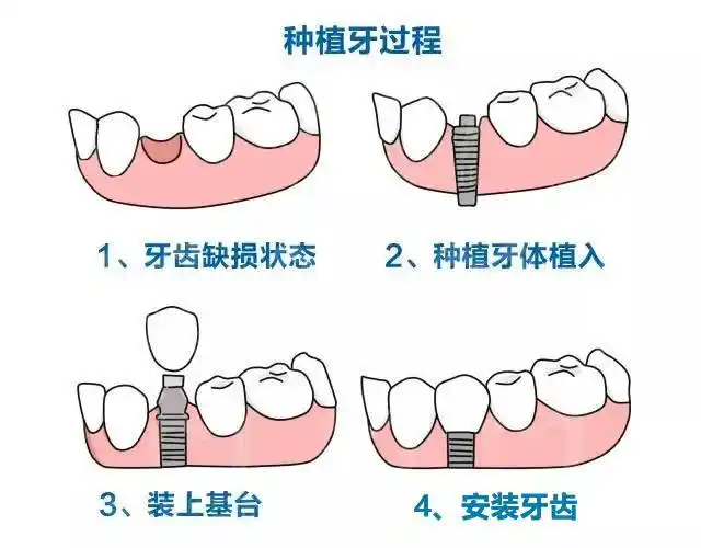 说到种植牙