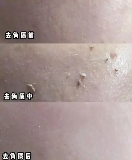 1分钟去陈年角质吸出身体老泥皮肤又白又滑