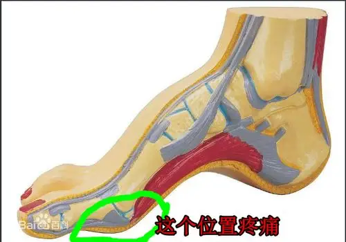 右脚前脚掌(最鼓的那个地方)疼了一个月了,走路多了症状会加剧,反之会
