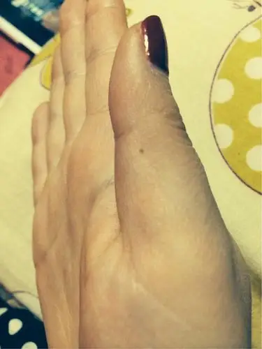 左手大拇指长了个痣,求解