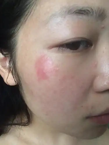 我脸上眼睛旁边瘙痒并出现一片红肿怎么回事,反反复复