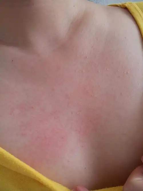 胸前长了一片小痘痘一样的点,有图