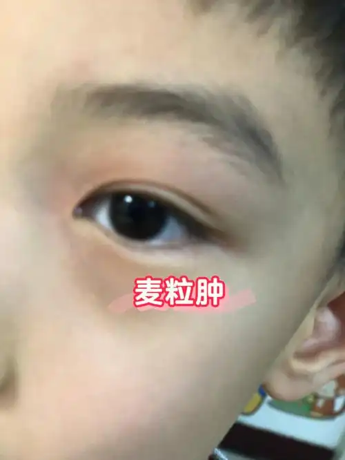 已经多次眼睛红肿,要起麦粒肿(针眼)了,又赶上疫情特殊时期,去医院