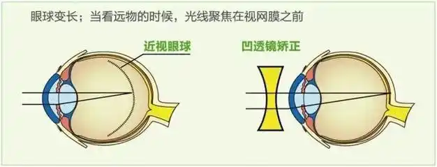 广州的儿童近视医院儿童假性近视治疗