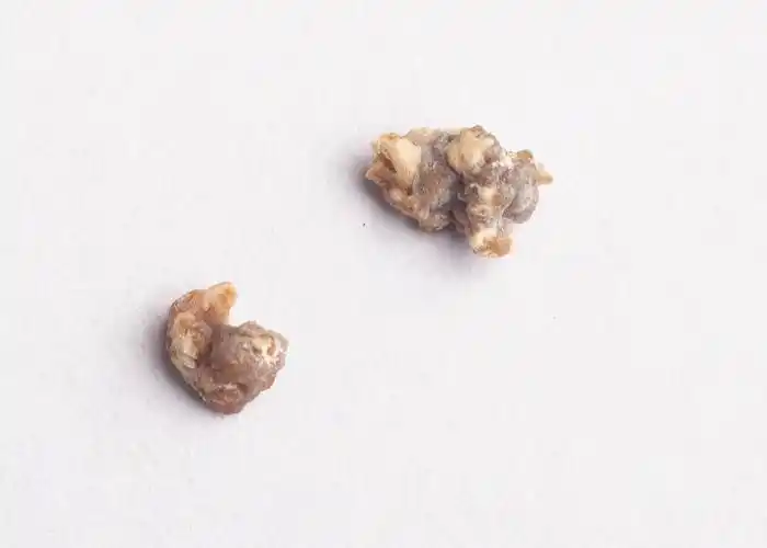 尿液中钙,草酸,尿酸等排出量增加,由于碳酸钙结晶或草酸钙晶体在尿液