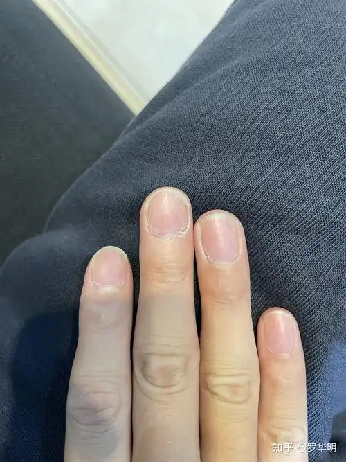 银屑病甲的悲催过程