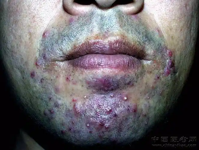 史上最全的皮肤病图谱来了(修订版)!