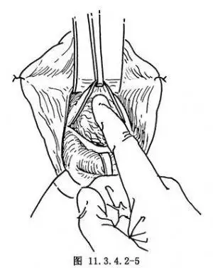 经阴道输卵管结扎术手术过程_百姓健康网
