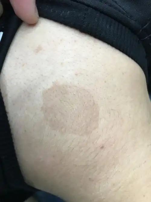 无缘无故长出这个斑,这是什么斑,严重不?