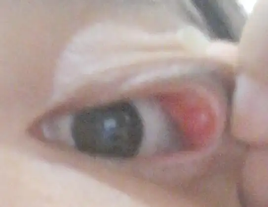 问:左眼上眼皮长了一个红包,不痛不痒就是感觉那里有点胀,都有二个多