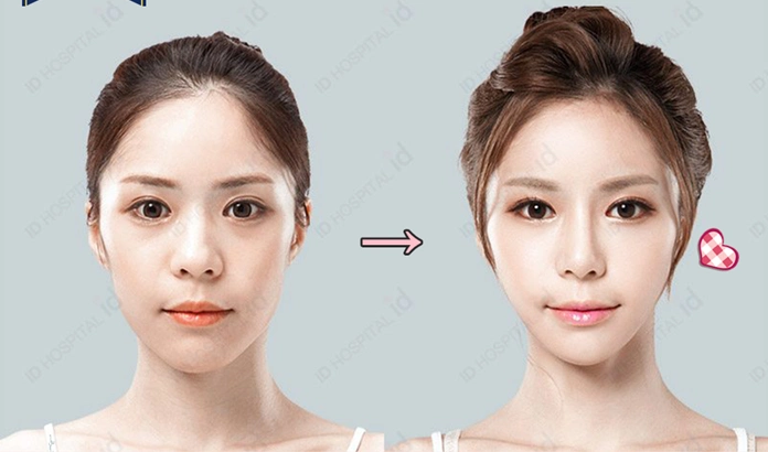 id韩国鼻子整形医院前后对比照片