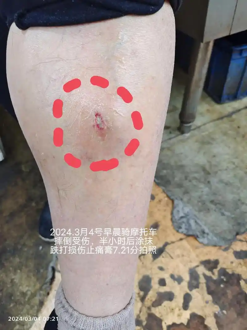 这是一个我认识的朋友,骑摩托车摔倒受伤的中年男性患者,他老婆