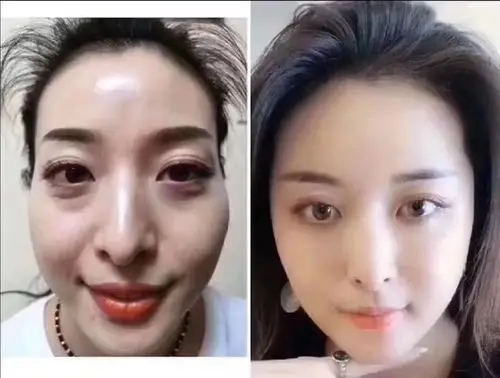 太阳穴面颊填充前后对比