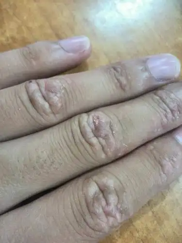 手指关节处,总是起水泡,褪皮,超级痒,怎么回事?