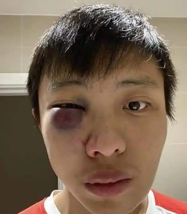 长着一副亚洲人面孔,新加坡学生被打得鼻青脸肿,英国佬拒绝道歉