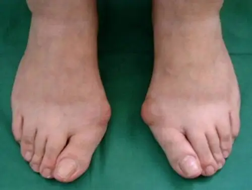 拇外翻患者x光图片_有来医生