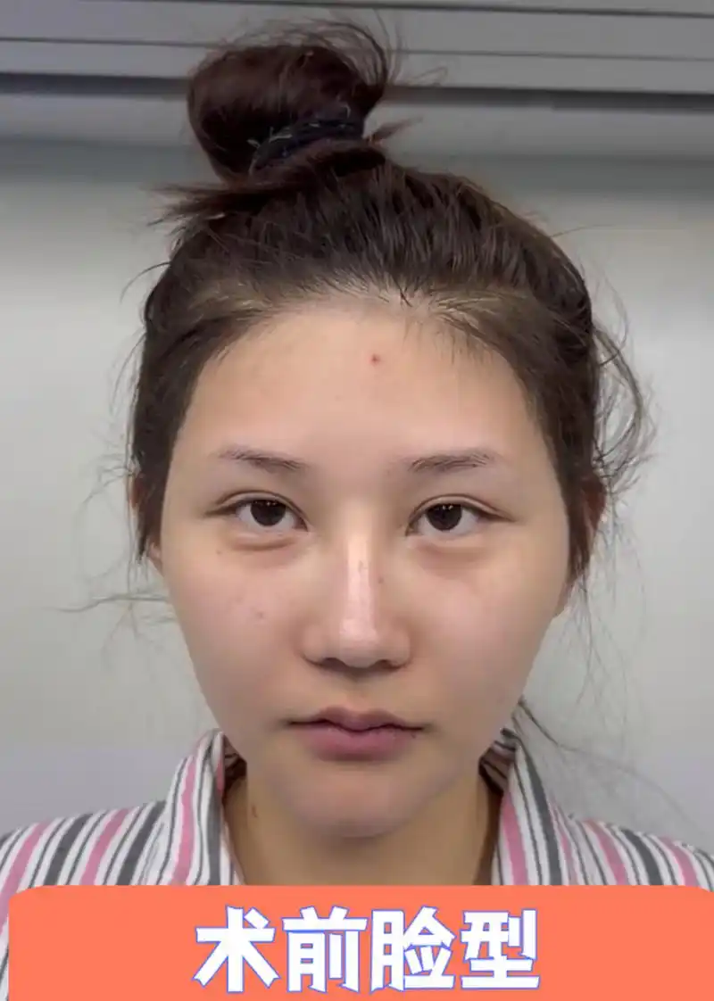 菱形脸做微创降颧骨,多久可以恢复?