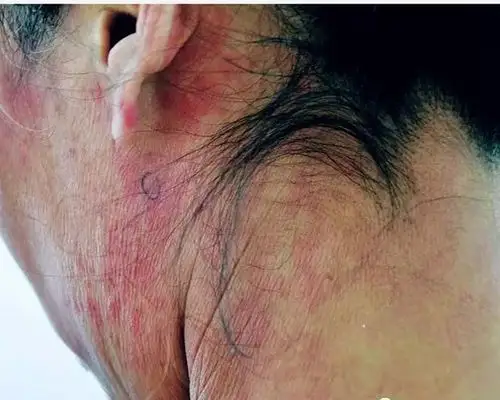 点状角化过度,表皮增生肥厚,棘层上部散在坏死角质形成细胞,真皮浅