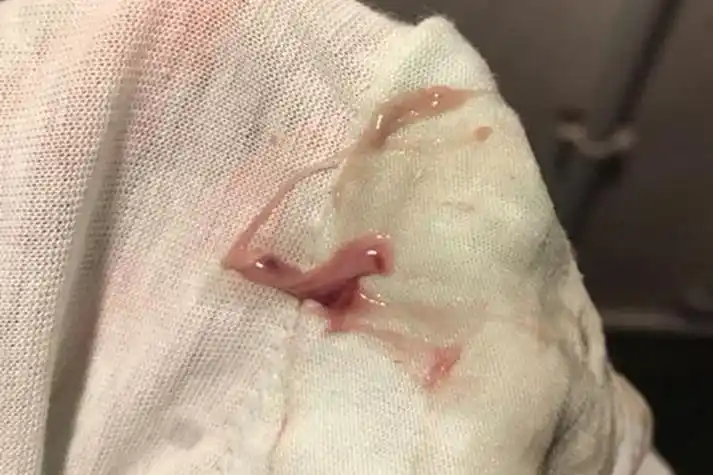 宫颈癌内裤血性分泌物图