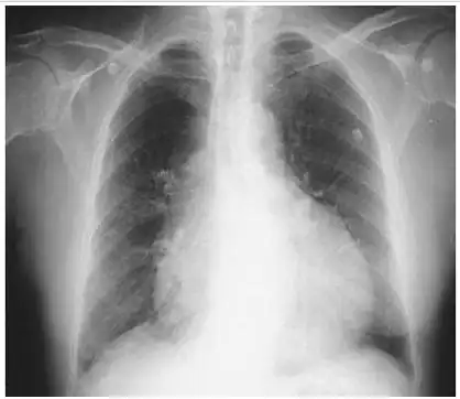 其典型胸片表现为心影增大,即所谓的烧瓶状心脏.