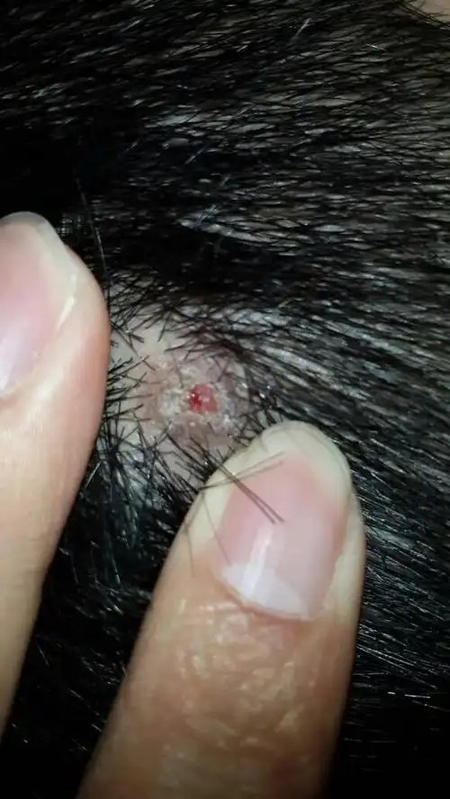 头上长了一颗东西去掉结痂是红色的,不痛不痒,有段时间会瘪下去.