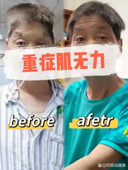 重症肌无力眼肌型发展为全身型